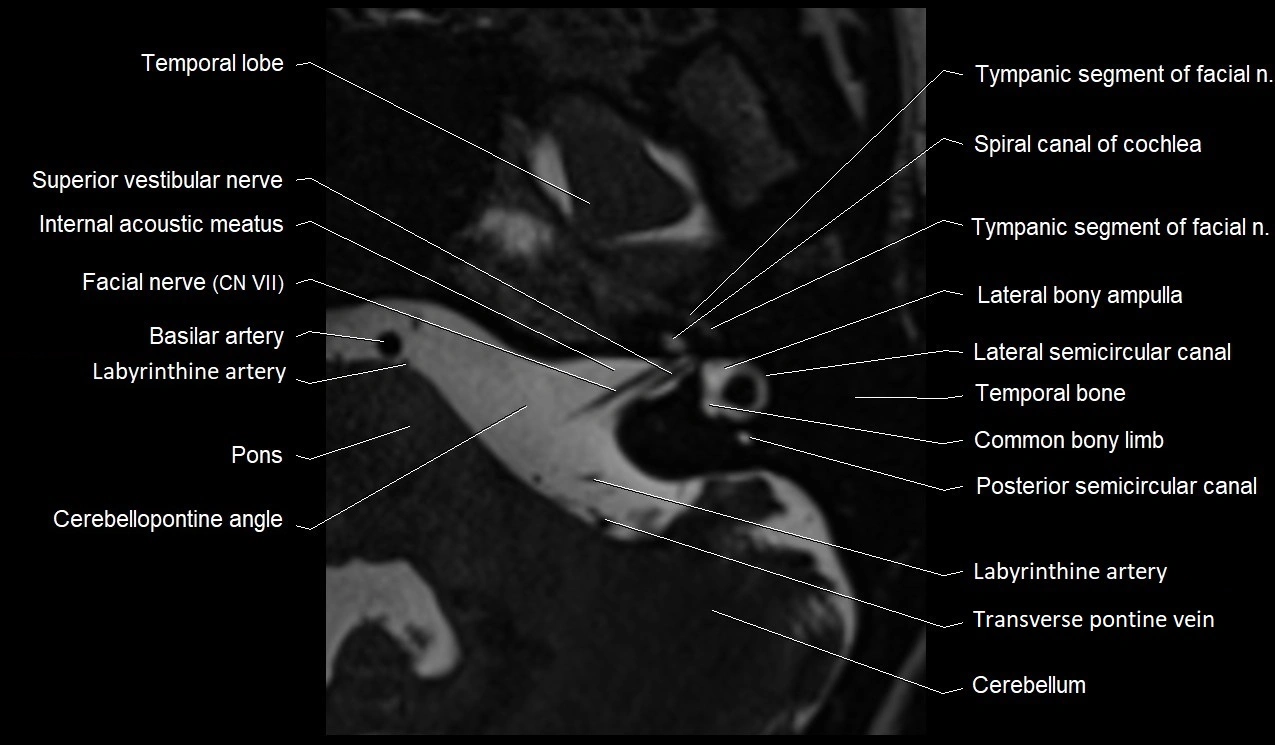 Internal auditory canal (IAC) axial cross sectional anatomy image 15.webp